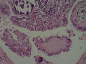 Características nucleares de carcinoma papilar. Marcada irregularidad del contorno nuclear, aclaramiento y sobreposición nuclear y hendiduras nucleares. Aumento 10×; tinción hematoxilina-eosina.