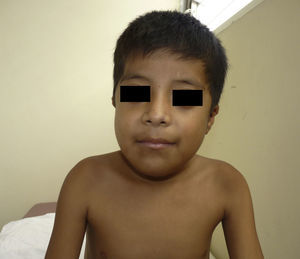 En la facies se observa proptosis, ptosis palpebral bilateral e hipoplasia mediofacial.
