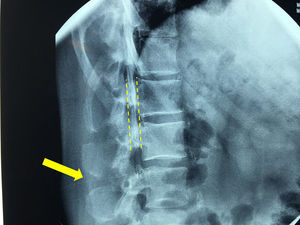 Visión fluoroscópica. Proyección lateral de columna lumbar. Catéter en espacio subaracnoideo (flecha) y canal espinal con contraste en su interior (línea de puntos).