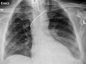 Radiografía de tórax luego de la inserción de catéteres vasculares.