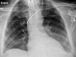 Chest X-ray after insertion of the vascular catheters.