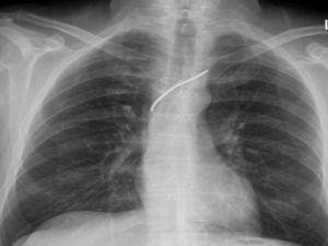 Chest X-ray before the current admission.