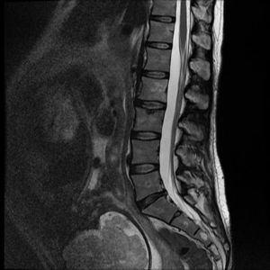 Resonancia magnética de columna lumbar. Incipiente discopatía degenerativa en L5-S1. Se descarta la existencia de malformación vascular vertebral o espinal.