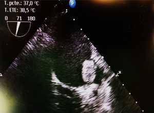 Imagen 2D de ecocardiografía transesofágica que muestra trombo en la orejuela izquierda.