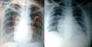 Chest X-ray of patients, at postpartum period. Case 1 has dextrocardia.