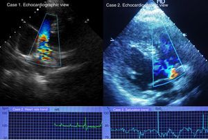 Echocardiographic views and saturation and heart rate trend graphs. Echocardiography images show shunt flows and its directions. Case 2 saturation trends show severe hypoxemia with high concentration mask oxygen.