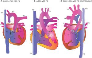 Transposition of Great Arteries; few variants. Case 1 had the third variety and case 2 had the first. SVC: superior vena cava; AO: aorta; PA: pulmonary artery; RA: right atrium; RV: right ventricle; LA: left atrium; LV: left ventricle; PV: pulmonary vein; IVC: inferior vena cava; VSD: ventricular septal defect; PS: pulmonary stenosis.