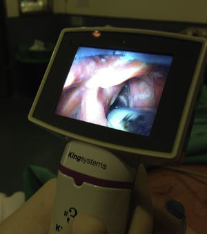 Intubación con videolaringoscopio. Se observa el paso del tubo a través de las cuerdas vocales.