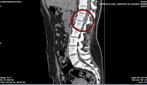 Tomografía axial computarizada de columna lumbosacra evidenciando lesión con densidad de tejidos blandos a nivel del agujero de conjugación derecho T12-L1.