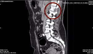 Corte adicional de tomografía axial computarizada de columna lumbosacra con lesión descrita que ensancha el agujero de conjugación, con compromiso del canal medular y compresión de la médula espinal hacia la izquierda y compromiso paravertebral.