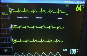 Patrón electrocardiográfico intraoperatorio tipo II.