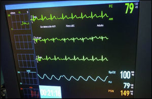 Patrón electrocardiográfico normalizado tras administración de atropina.