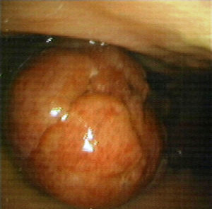 Pólipo pediculado en cuerpo gástrico.