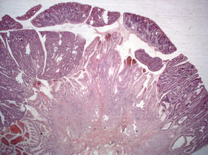 Pólipo hiperplásico con adenocarcinoma bien diferenciado (HE 12.5x).