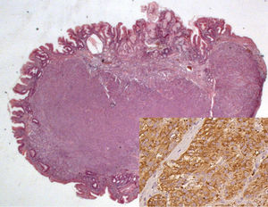 Tumor neuroendócrino (HE 12.5x); en detalle inmunohistoquímica positiva para cromogranina (400x).