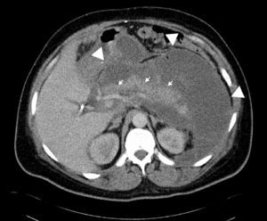Large pancreatic pseudocyst (white arrows) surrounding the pancreas and compressing hollow viscus. Small arrows show the location of the pancreas.