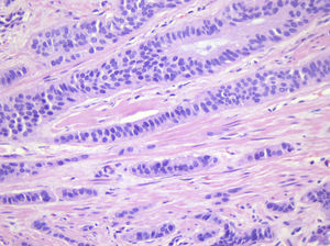 Detalle de las células neoplásicas. Las células neoplásicas eran ovoides con citoplasma escaso, los núcleos mostraban cromatina grumosa a densa. No se observaron mitosis (Hematoxilina & Eosina, 40x).
