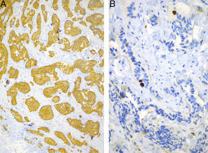 Inmunoreacciones. A) Sinaptofisina. B) Ki-67 (MIB-1). Las tinciones de inmunohistoquímica para confirmar la estirpe neuroendocrina (sinaptofisina y cromogranina A) fueron positivas. La proliferación celular (Ki-67) fue de 1%. El diagnóstico fue de tumor neuroendocrino bien diferenciado grado I (tumor carcinoide).
