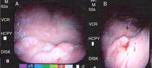 Endoscopia digestiva superior. A) Lesión tipo IIa. B) Lesión tipo IIa+c.