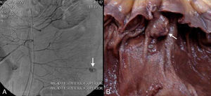 A) Angiografía de arteria mesentérica superior donde se evidencia fuga del material de contrastes a nivel de ramas yeyunales (flecha). B) Corte de pólipo yeyunal correspondiente a coriocarcinoma metastásico (flecha).