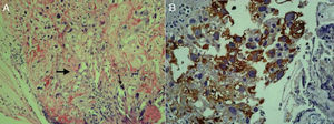 A) Fotomicrografía (10X, H&E). Neoplasia con células de sincicio (flecha delgada) y citotrofoblasto (flecha gruesa), rodeadas por necrosis. B) Fotomicrografía (40X, Inmunohistoquímica). Células de citotrofoblasto con tinción de gonadotropina coriónica intensamente positiva en el citoplasma.