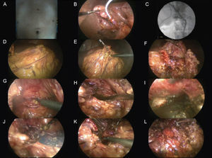 Técnica de drenaje interno posterior laparoscópico. A) Posición de los trocares. B) y C) Colangiografía transcística. D) a L) Abordaje posterior.