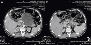 A) Tomografía computarizada preoperatoria. B) Tomografía computarizada a los 2 meses del procedimiento quirúrgico.