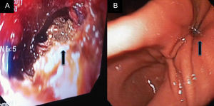 A) Endoscopia transoperatoria mostrando la cistogastroanastomosis, con detritus necróticos en el fondo (flecha). B) Endoscopia al mes del procedimiento quirúrgico, mostrando estenosis de mas del 90,0% de en la anastomosis (flecha).