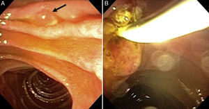 A) Papila mayor duodenal (señalada con la flecha). B) Lito extraído con sonda de balón, posterior a la esfinterotomía endoscópica.