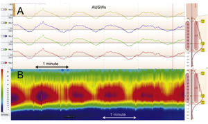 Presencia de ondas anales ultralentas detectadas por manometría convencional (A) y manometría de alta definición (B). (Imágenes originales, Dr. José María Remes Troche.).