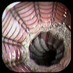 The image shows the stent application.