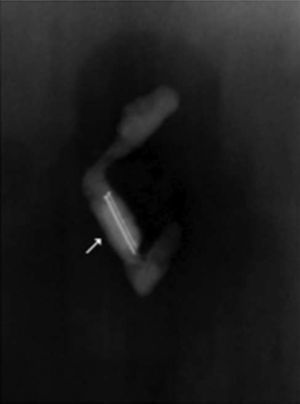 Radiografía de la pieza quirúrgica que muestra 2 alfileres dentro del lumen apendicular.