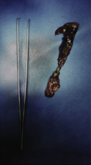 Apéndice cecal con peritonitis fibrinopurulenta y necrosis. Alfileres en su interior no mostrados.