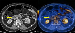 Tomografía por emisión de positrones-tomografía computarizada (PET/TC).