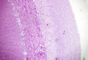 Histopatología, tinción de hematoxilina y eosina: serosa del intestino con banda fibrosa que oblitera la luz.