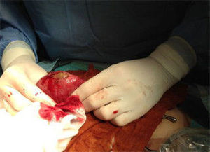 Extracción de íleo biliar mediante incisión de asistencia.