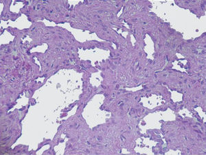 Fotomicrografía de pared intestinal que muestra numerosos vasos linfáticos dilatados, con presencia de escaso material proteinaceo en su interior (hematoxilina-eosina, x10).