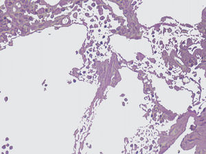 Fotomicrografía de biopsia intestinal, la cual muestra múltiples vasos linfáticos dilatados adyacentes a glándulas intestinales de aspecto normal (hematoxilina-eosina, x40).