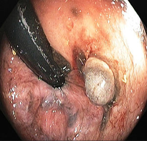 Melanoma rectal. Se observa una tumoración vegetante hipercrómica adyacente al borde anal, indicativa de melanoma.