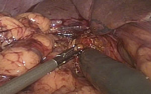 Visión laparoscópica del gastroscopio entrando a la coledocotomía, a través de un puerto de trabajo quirúrgico (trócar) mediante la tracción con un grasper laparoscópico.