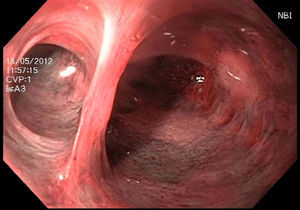 Visión endoscópica de una coledocoscopia transquirúrgica transabdominal con aplicación de NBI, que muestra vía biliar sin cálculos. NBI: narrow band image (imagen de banda estrecha).