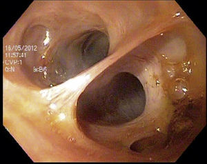 Visión endoscópica de una coledocoscopia transquirúrgica transoral a través de la coledocoduodeno-anastomosis, que muestra vía biliar intrahepática libre de cálculos.