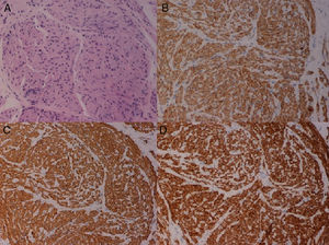 A) Proliferación neoplásica constituida por fascículos cortos de células fusiformes sin atipia (HE×20). B) Positividad inmunohistoquímica para marcadores de músculo liso (×20). C) Positividad para desmina (×20). D) Positividad para H-caldesmon (×20).