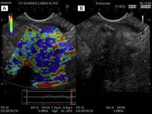 A) Imagen de elastografía de adenocarcinoma en cuello de páncreas. Se observa un centro en color azul que corresponde al tumor (tejido rígido), sitio donde se realizó la BAAF. Rodeando al tumor, tejido pancreático normal (suave). B) Imagen en modo B de USE de una lesión hipoecoica, heterogénea de bordes irregulares en cuello de páncreas que corresponde a un adenocarcinoma de páncreas en cuello de páncreas. No es posible diferenciar el tumor del tejido pancreático normal circundante.