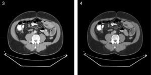 Imágenes de la tomografía axial. Se objetiva el asa que está involucrada en la intususcepción.