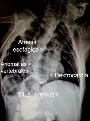 Radiografía de tórax y abdomen señalando las alteraciones encontradas en la asociación VACTERL.