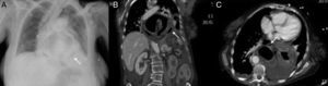 Radiografía tórax. A) Gran hernia hiatal con burbuja de aire paragástrico probablemente ectópico (flecha negra). Derrame pleural izquierdo. TC: en plano coronal (B) y axial (C): herniación gástrica paraesofágica con volvulación organoaxial. Disposición intratorácica del fundus y cuerpo con normal localización de la unión gastroduodenal. Las paredes gástricas herniadas presentan engrosamiento concéntrico por edema y escaso realce de contraste por sufrimiento isquémico. Existen múltiples burbujas de gas ectópicas (flecha blanca) y líquido en el saco herniario por perforación visceral.