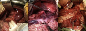 Imágenes de la cirugía: A) Tras rechazar lóbulo hepático izquierdo, se observa hernia paraesofágica con estómago intratorácico y de aspecto isquémico (flecha blanca). B) Tras reducción del estómago herniado, isquemia que afecta a la curvatura mayor (línea puntos blanca) y perforación de 3cm a nivel de la misma en el cuerpo gástrico (flecha blanca). C) Gastrectomía tipo tubular resecando curvatura mayor isquémica y perforación gástrica (flecha blanca tubulización gástrica, flecha blanca puntos resección gástrica).