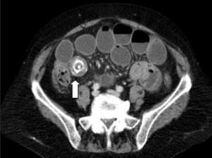 Tomografía abdominal: mujer de 75 años de edad con cuadro de oclusión de intestino delgado secundario a litiasis ectópica (flecha).