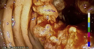 Colonoscopia con lesión de bordes irregulares, friable, a 13cm del margen anal, con diagnóstico histopatológico de adenocarcinoma.